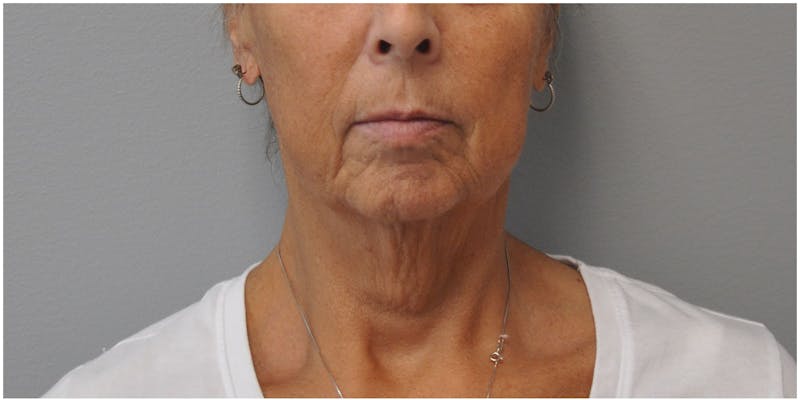 Facelift Before & After Gallery - Patient 651796 - Image 1