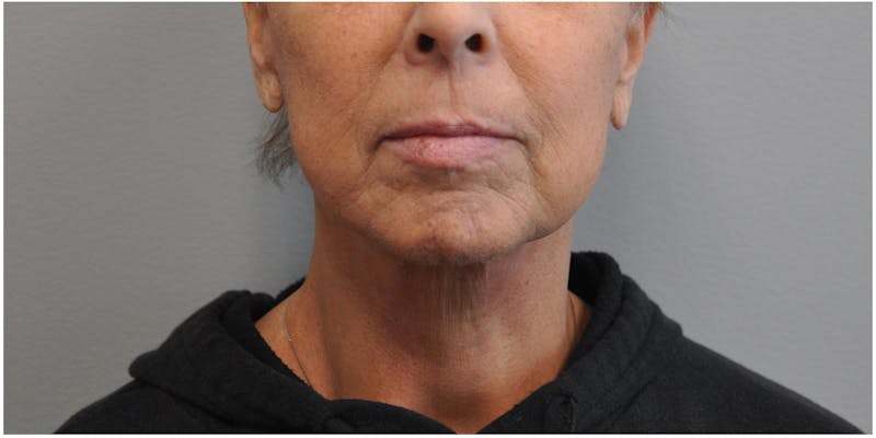 Facelift Before & After Gallery - Patient 651796 - Image 2
