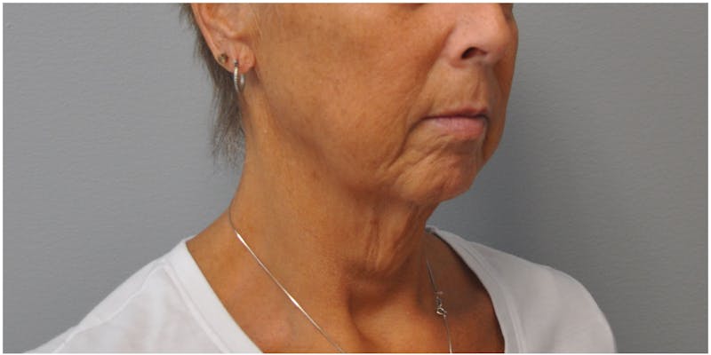 Neck Lift Before & After Gallery - Patient 129671 - Image 3