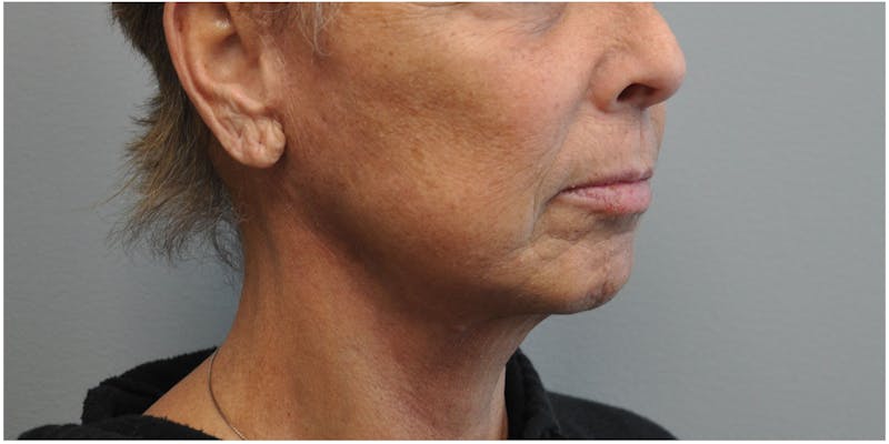 Facelift Before & After Gallery - Patient 651796 - Image 4
