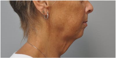 Neck Lift Before & After Gallery - Patient 129671 - Image 1