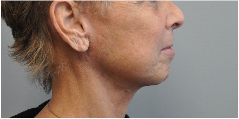 Neck Lift Before & After Gallery - Patient 129671 - Image 2