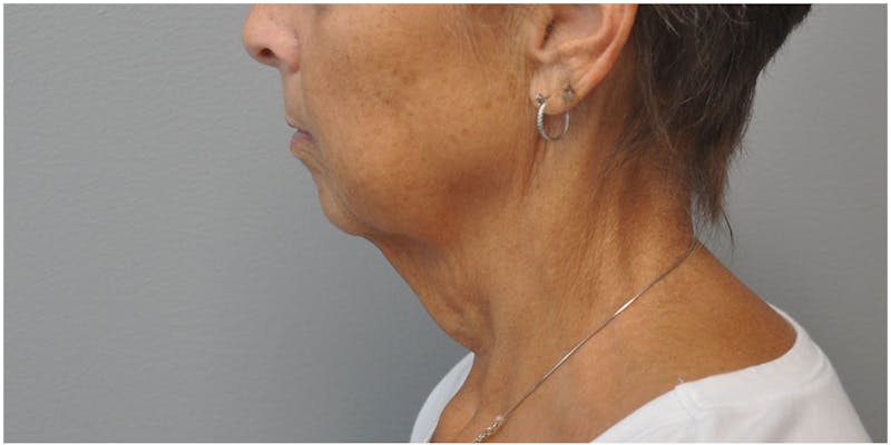 Neck Lift Before & After Gallery - Patient 129671 - Image 7