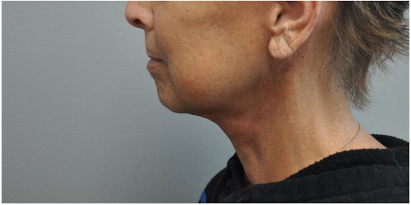 Neck Lift Before & After Gallery - Patient 129671 - Image 8