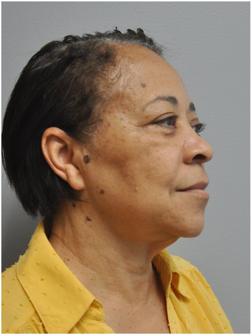 Neck Lift Before & After Gallery - Patient 345637 - Image 3