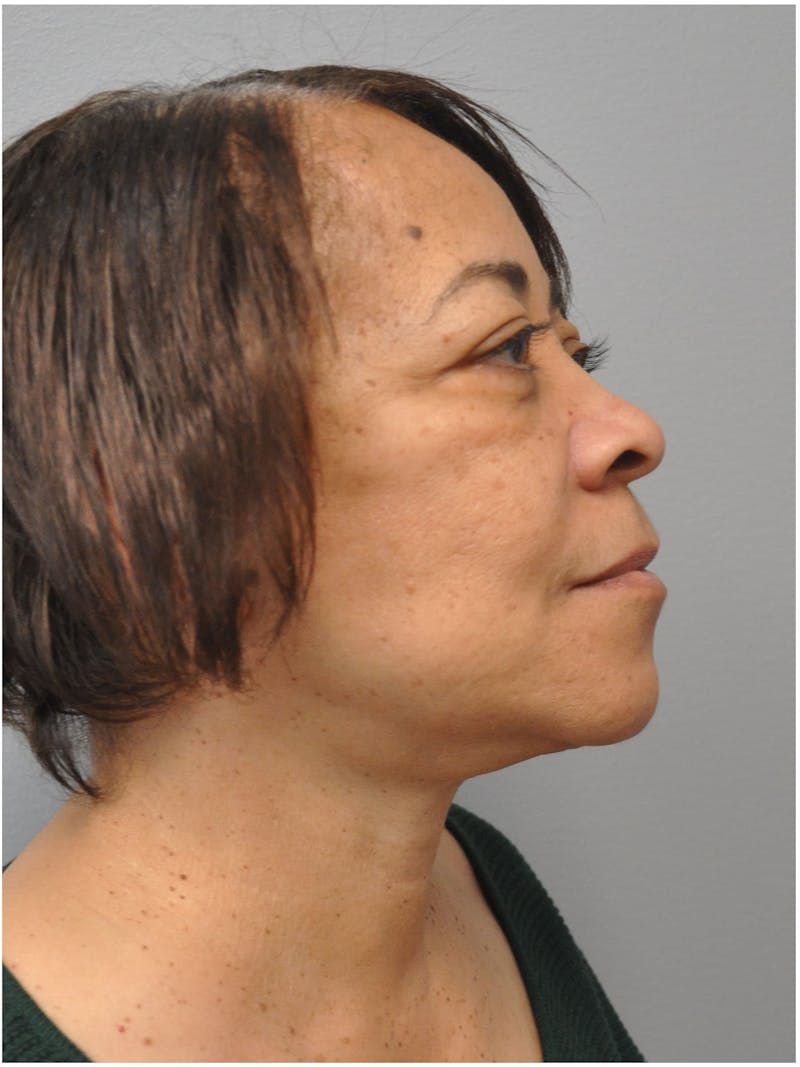Facelift Before & After Gallery - Patient 197917 - Image 4