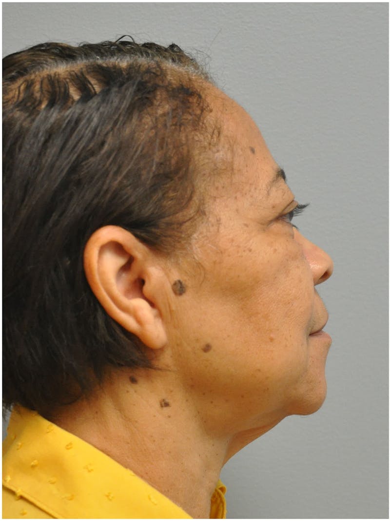 Facelift Before & After Gallery - Patient 197917 - Image 5