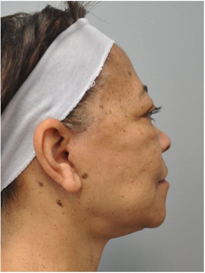 Neck Lift Before & After Gallery - Patient 345637 - Image 2