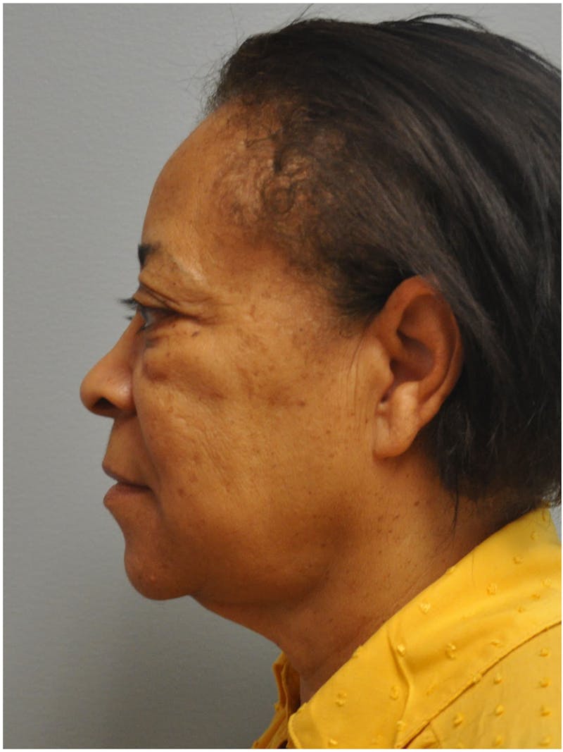 Neck Lift Before & After Gallery - Patient 345637 - Image 9
