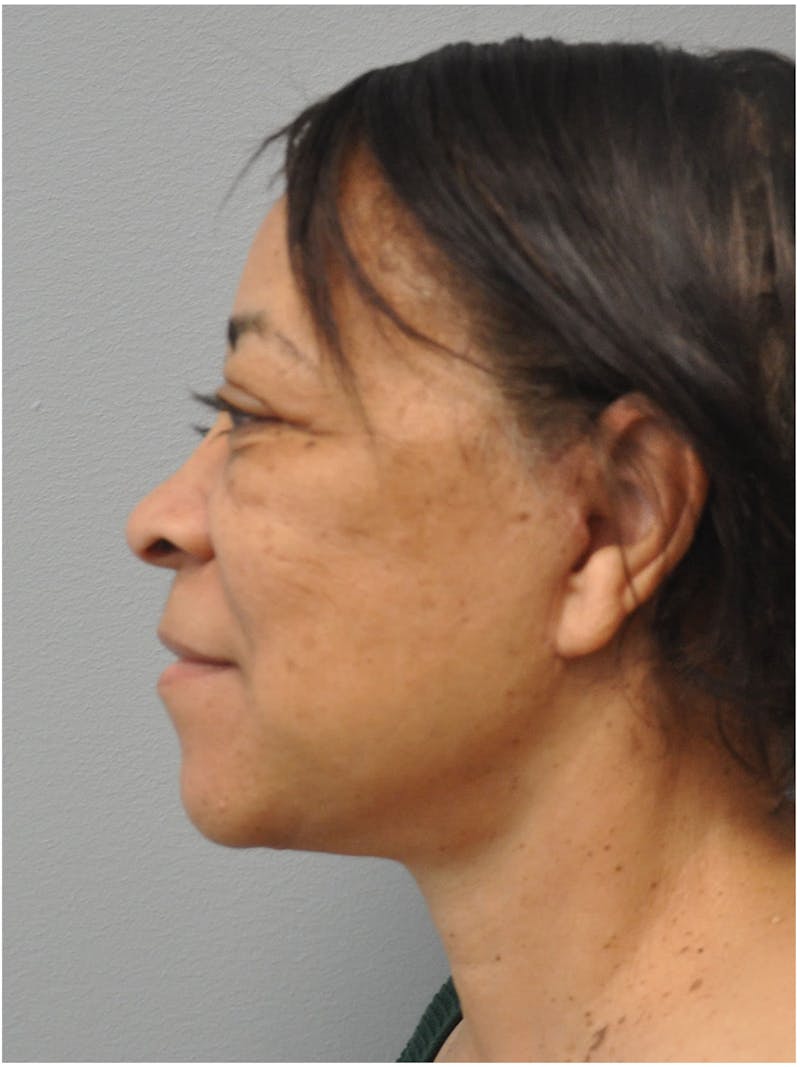 Facelift Before & After Gallery - Patient 197917 - Image 10