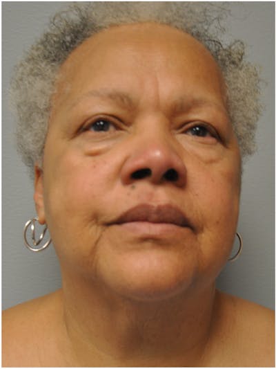 Facelift Before & After Gallery - Patient 138294 - Image 1