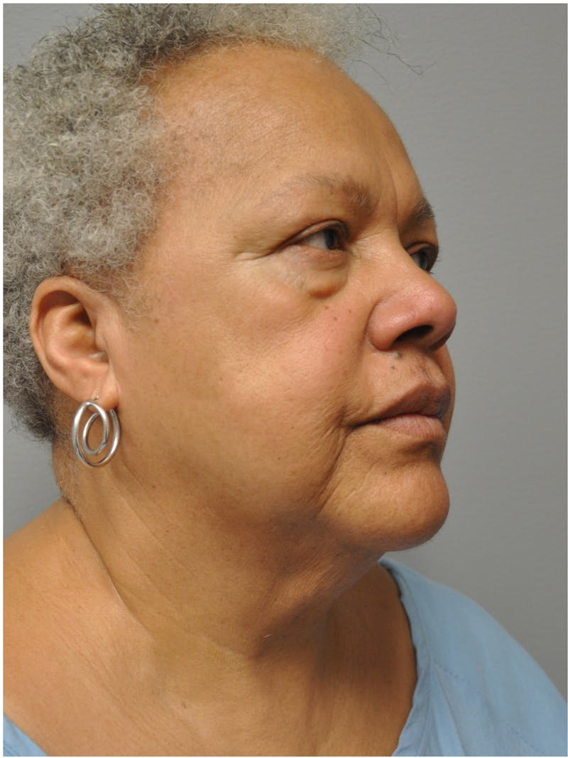 Facelift Before & After Gallery - Patient 138294 - Image 3