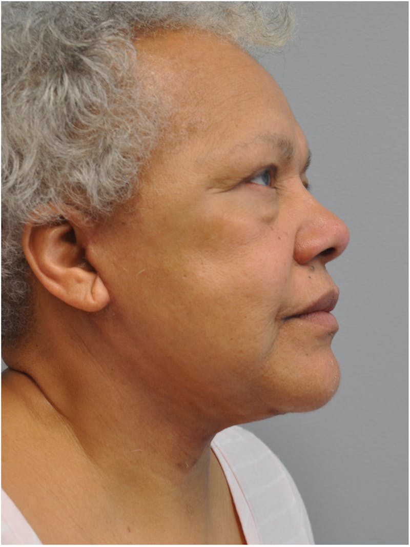 Facelift Before & After Gallery - Patient 138294 - Image 4