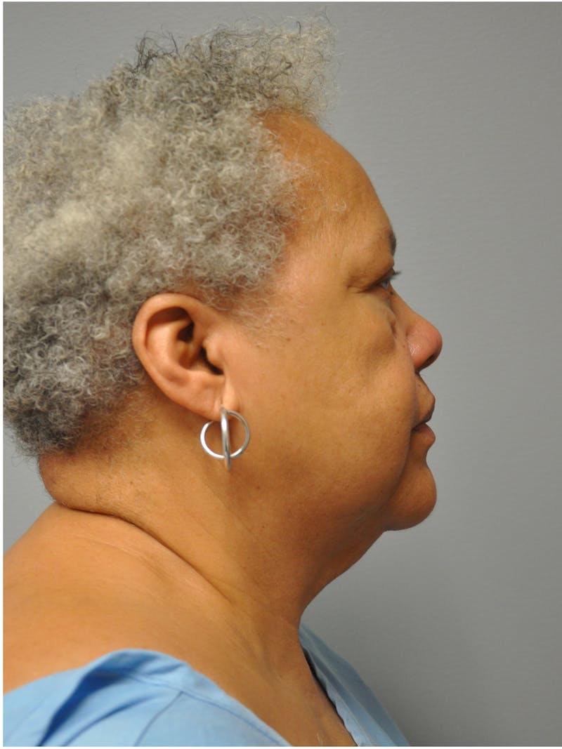 Facelift Before & After Gallery - Patient 138294 - Image 5