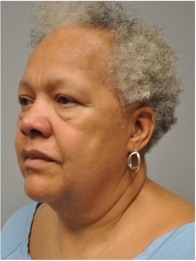 Facelift Before & After Gallery - Patient 138294 - Image 7