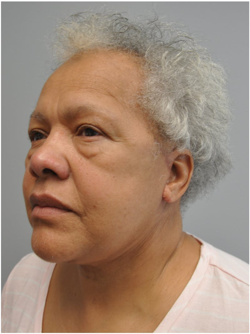 Facelift Before & After Gallery - Patient 138294 - Image 8