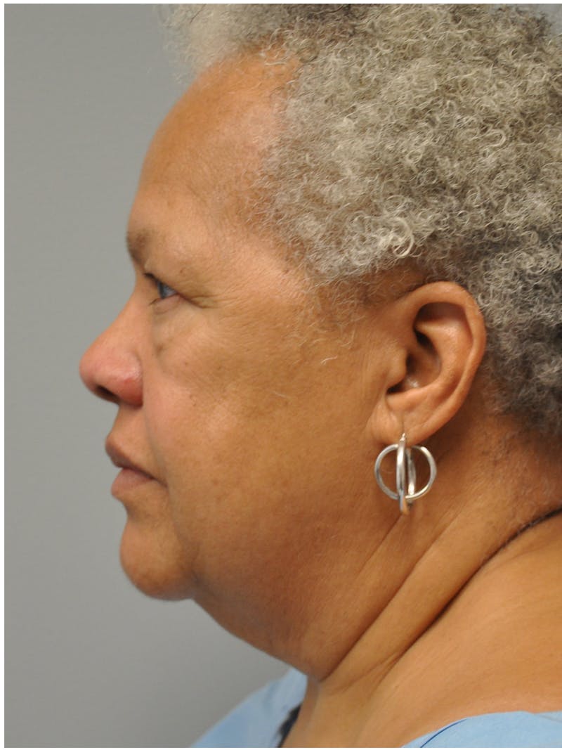 Facelift Before & After Gallery - Patient 138294 - Image 9