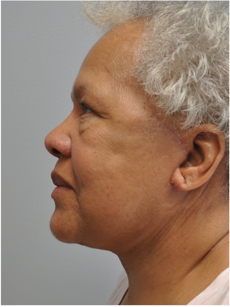 Facelift Before & After Gallery - Patient 138294 - Image 10