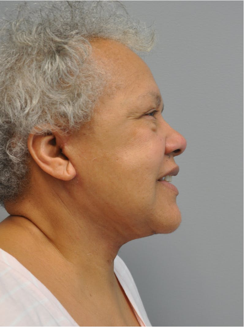 Facelift Before & After Gallery - Patient 138294 - Image 6