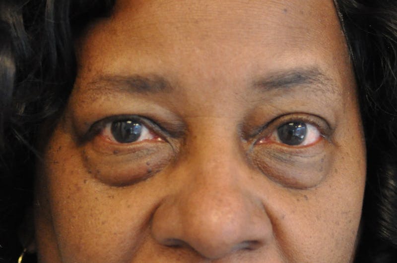 Eyelid Surgery Before & After Gallery - Patient 104422 - Image 1