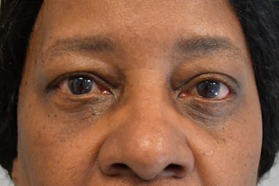 Eyelid Surgery Before & After Gallery - Patient 104422 - Image 2