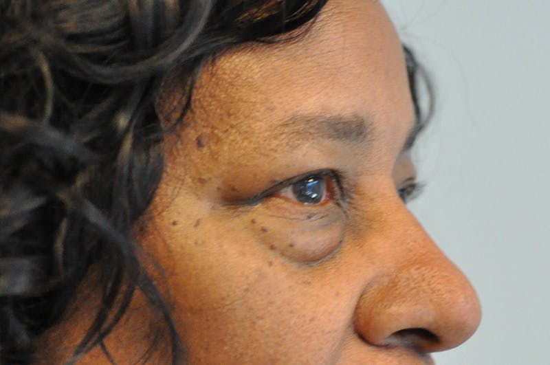 Eyelid Surgery Before & After Gallery - Patient 104422 - Image 3