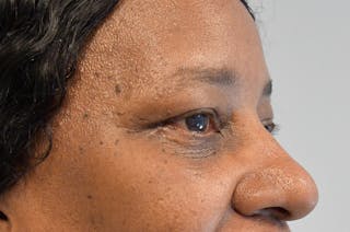 Eyelid Surgery Before & After Gallery - Patient 104422 - Image 4