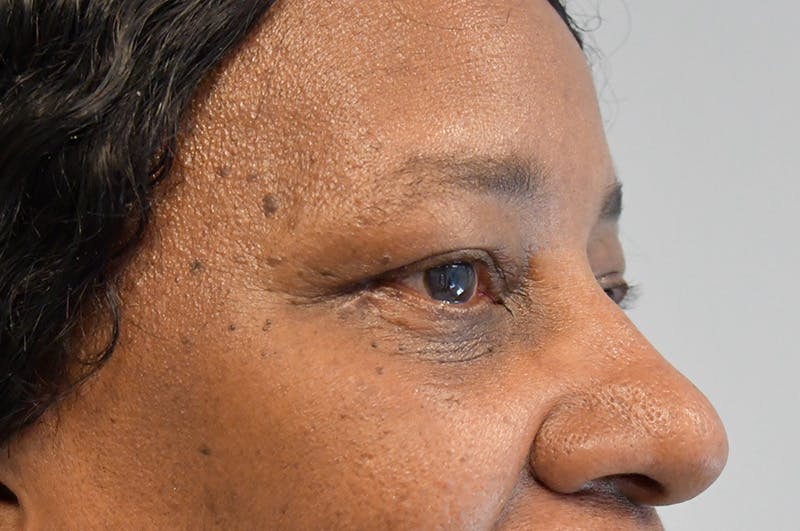 Eyelid Surgery Before & After Gallery - Patient 104422 - Image 4