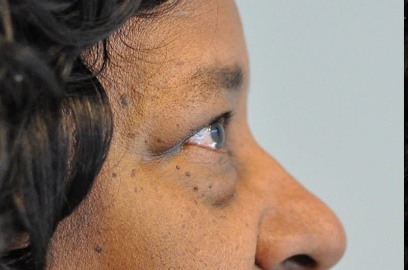 Eyelid Surgery Before & After Gallery - Patient 104422 - Image 5