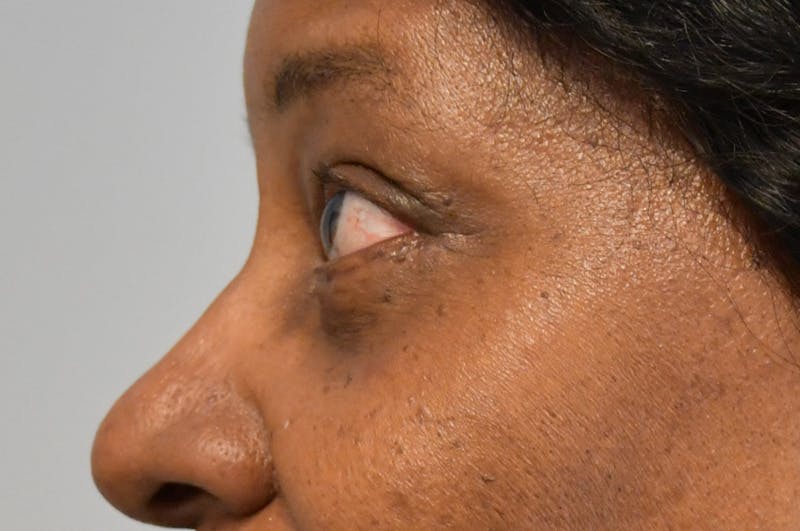 Eyelid Surgery Before & After Gallery - Patient 104422 - Image 8