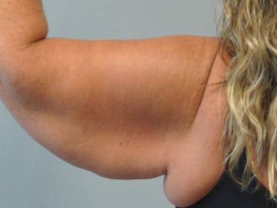 Arm Lift Before & After Gallery - Patient 678167 - Image 1