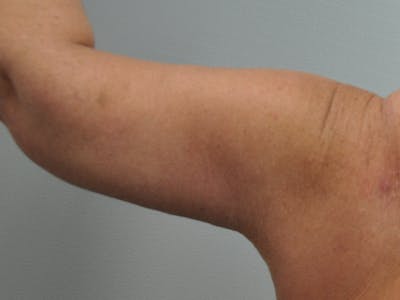 Arm Lift Before & After Gallery - Patient 678167 - Image 2