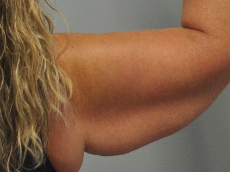 Arm Lift Before & After Gallery - Patient 678167 - Image 3