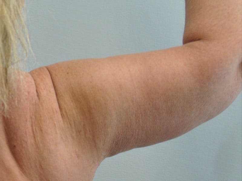 Arm Lift Before & After Gallery - Patient 678167 - Image 4