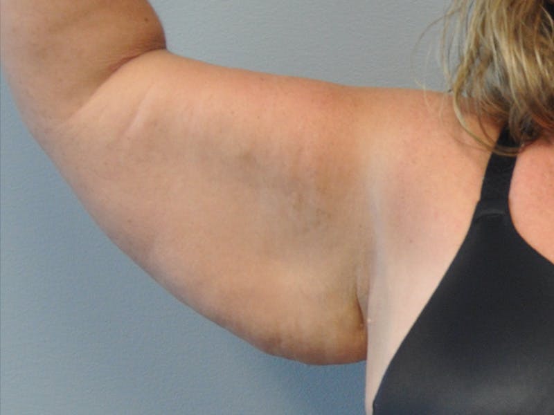 Arm Lift Before & After Gallery - Patient 678167 - Image 5