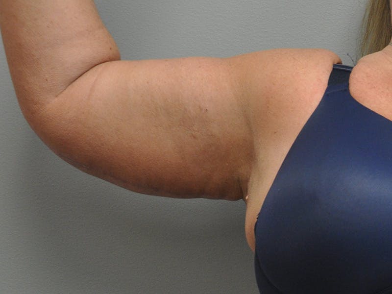 Arm Lift Before & After Gallery - Patient 678167 - Image 6