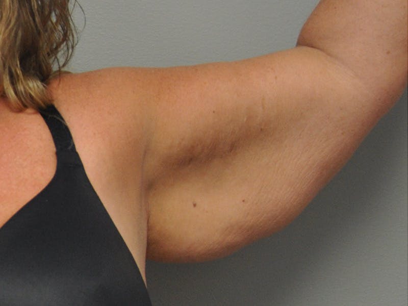 Arm Lift Before & After Gallery - Patient 678167 - Image 7