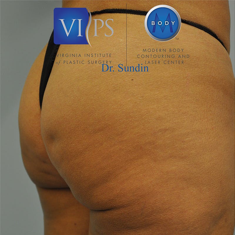 Aveli Before & After Gallery - Patient 414340 - Image 3