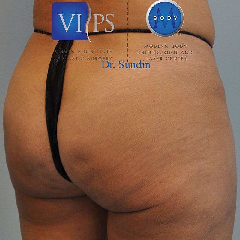 Aveli Before & After Gallery - Patient 414340 - Image 4