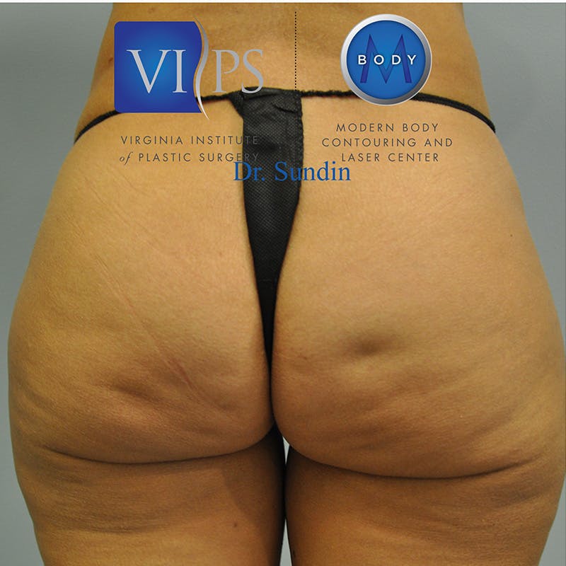 Aveli Before & After Gallery - Patient 414340 - Image 5