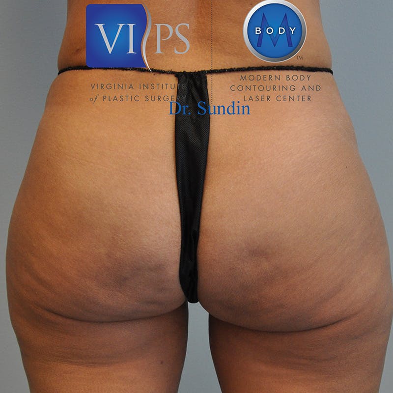 Aveli Before & After Gallery - Patient 414340 - Image 6