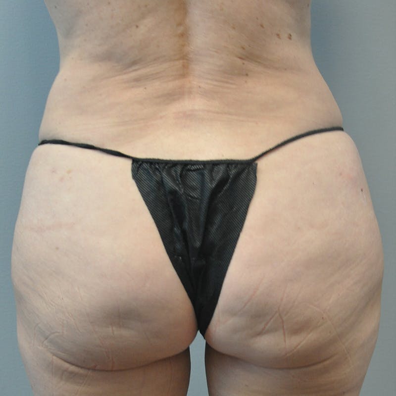 Aveli Before & After Gallery - Patient 833364 - Image 1