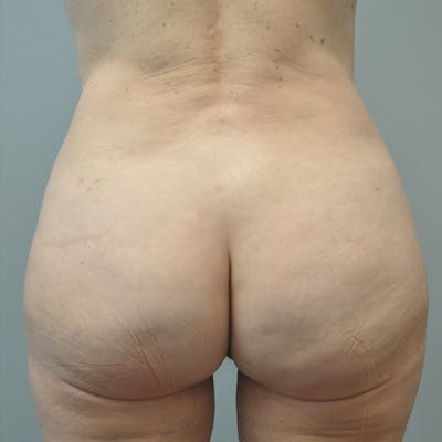 Aveli Before & After Gallery - Patient 833364 - Image 2