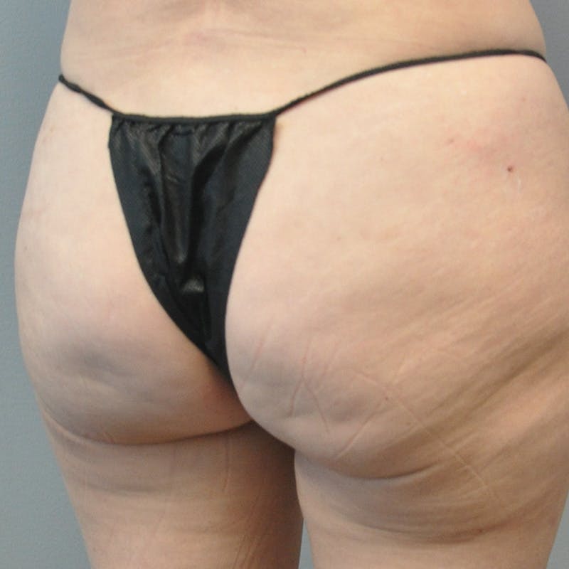 Aveli Before & After Gallery - Patient 833364 - Image 3