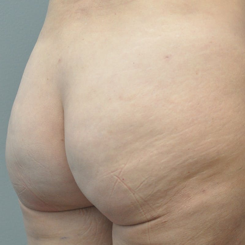 Aveli Before & After Gallery - Patient 833364 - Image 4