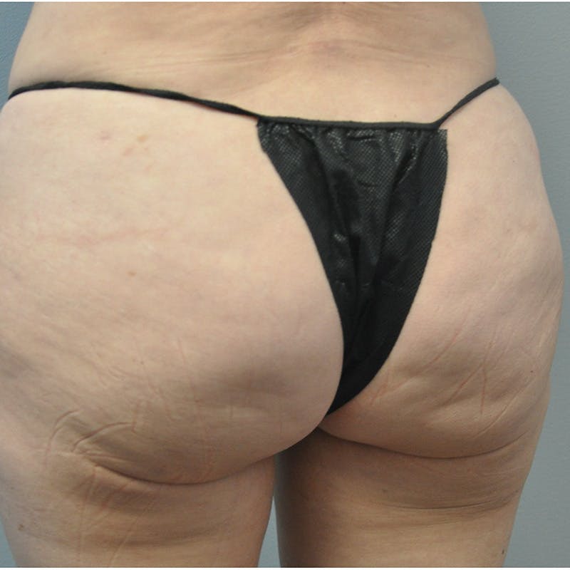 Aveli Before & After Gallery - Patient 833364 - Image 5