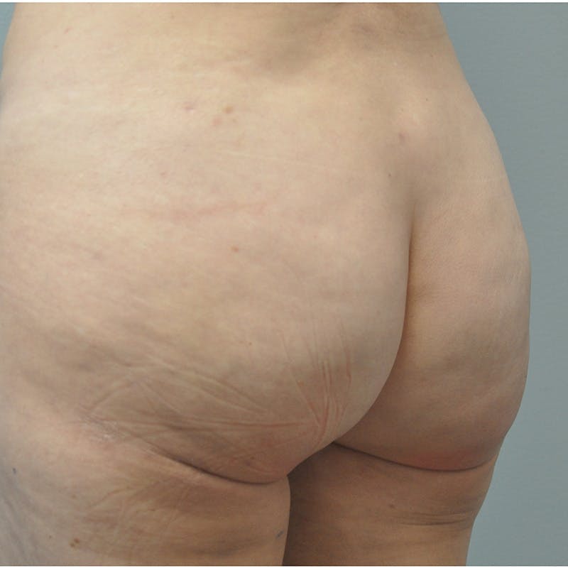 Aveli Before & After Gallery - Patient 833364 - Image 6