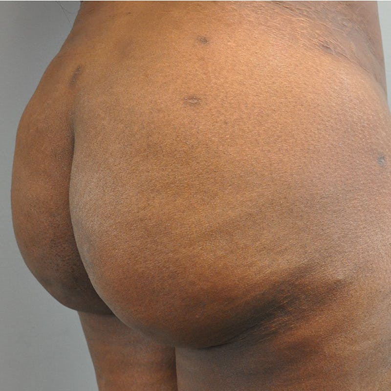 Aveli Before & After Gallery - Patient 706690 - Image 4