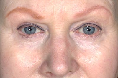 Eyelid Surgery Before & After Gallery - Patient 378862 - Image 1