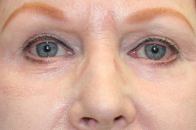 Eyelid Surgery Before & After Gallery - Patient 378862 - Image 2